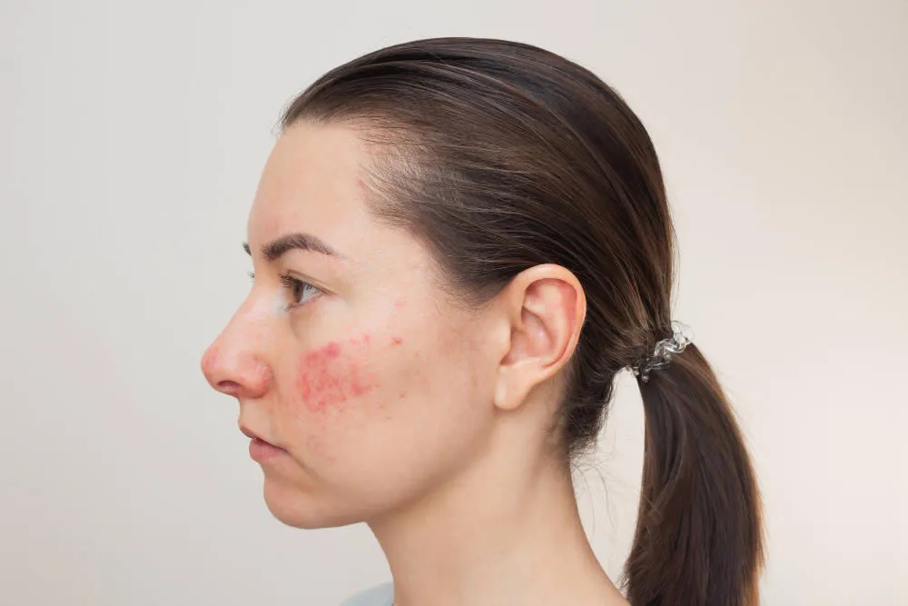woman-with-rosacea-face-dermatological-problems