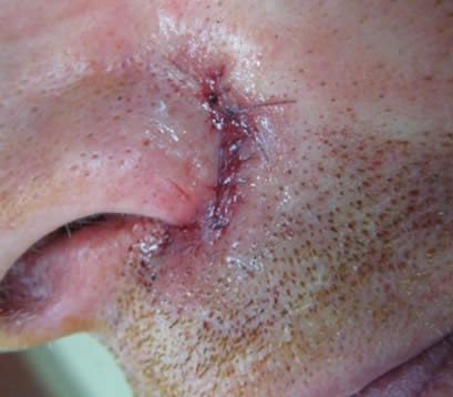 Skin cancer on face post MOHS surgery closure