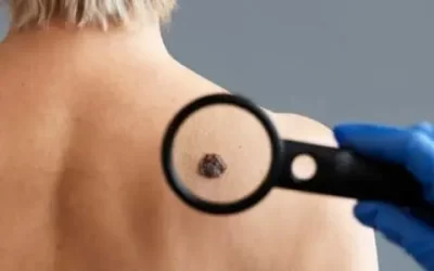 The Importance of Checking Your Moles