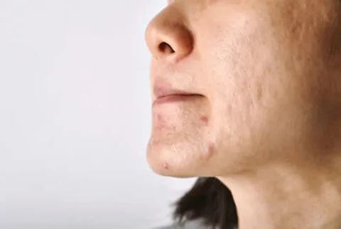 skin-problem-with-acne-scars